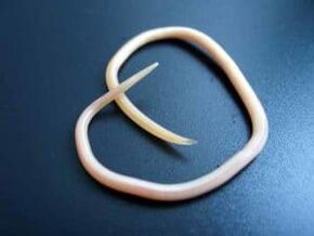Human roundworm removed from the body