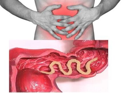 Signs of chronic helminthiasis are a dyspeptic bowel disorder. 