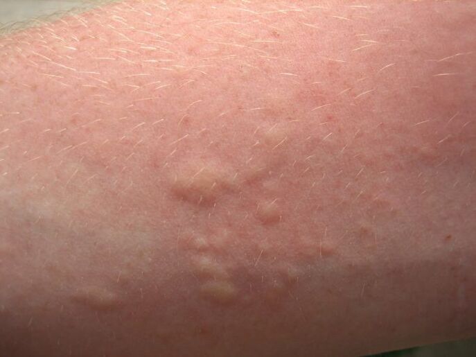 Itchy allergic skin rashes may be symptoms of ascariasis