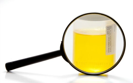 Urine test to diagnose schistosomiasis.
