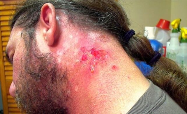 Bleeding neck wound with Morgellons virus