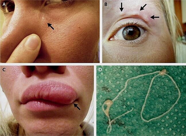 The main manifestations of heartworm on the face. 