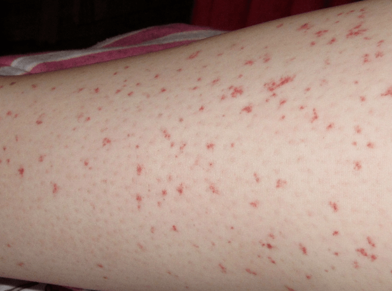 The skin rash is a sign of an acute stage of worm infection. 